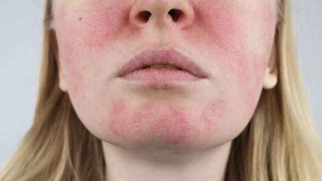 Uczulenie na proszek do pieczenia objawy – nie bagatelizuj reakcji alergicznych